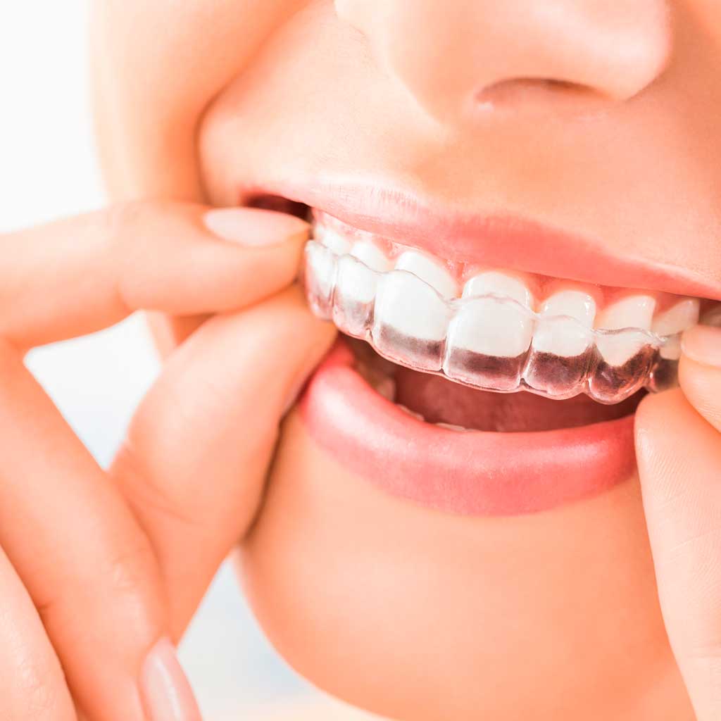 INVISALIGN_2_Q